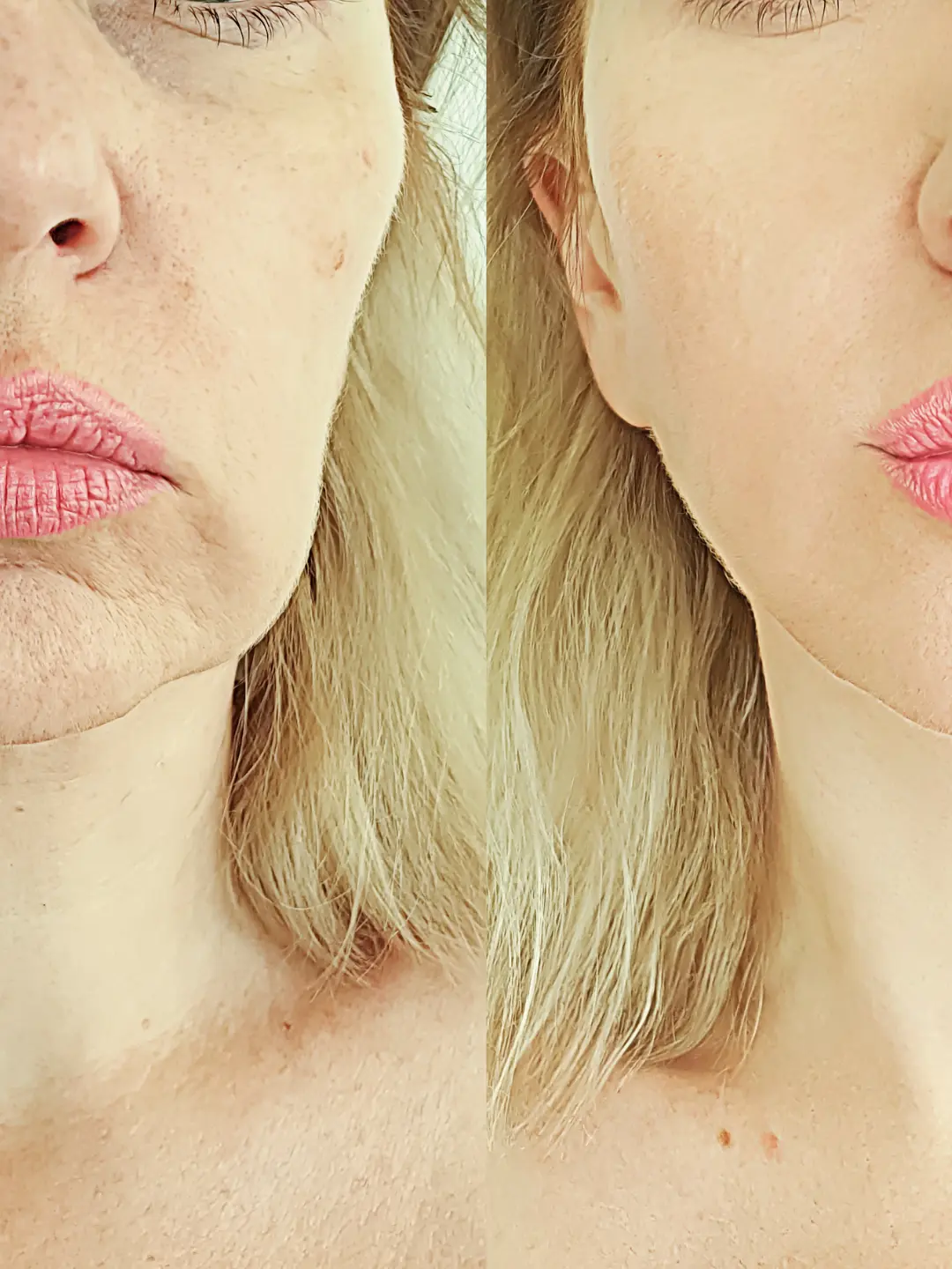 Tratamento facial da mulher: antes e depois.