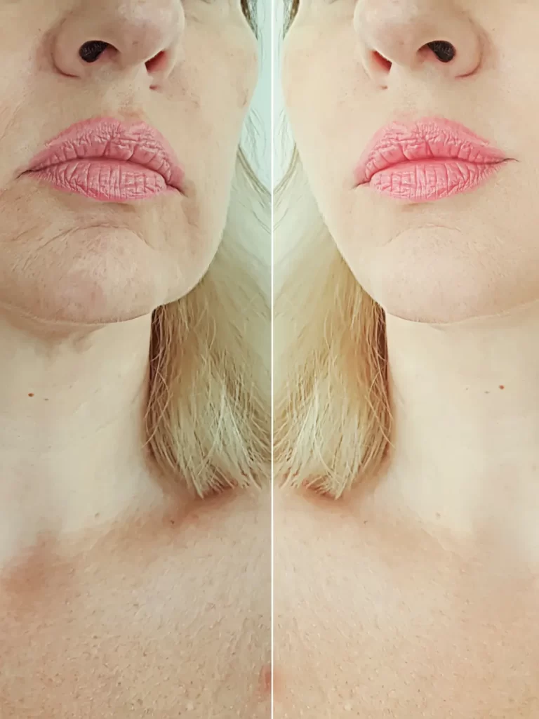 Tratamento facial da mulher: antes e depois.