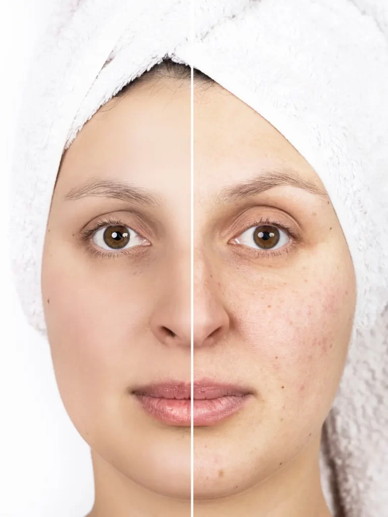 Tratamento facial da mulher: antes e depois.
