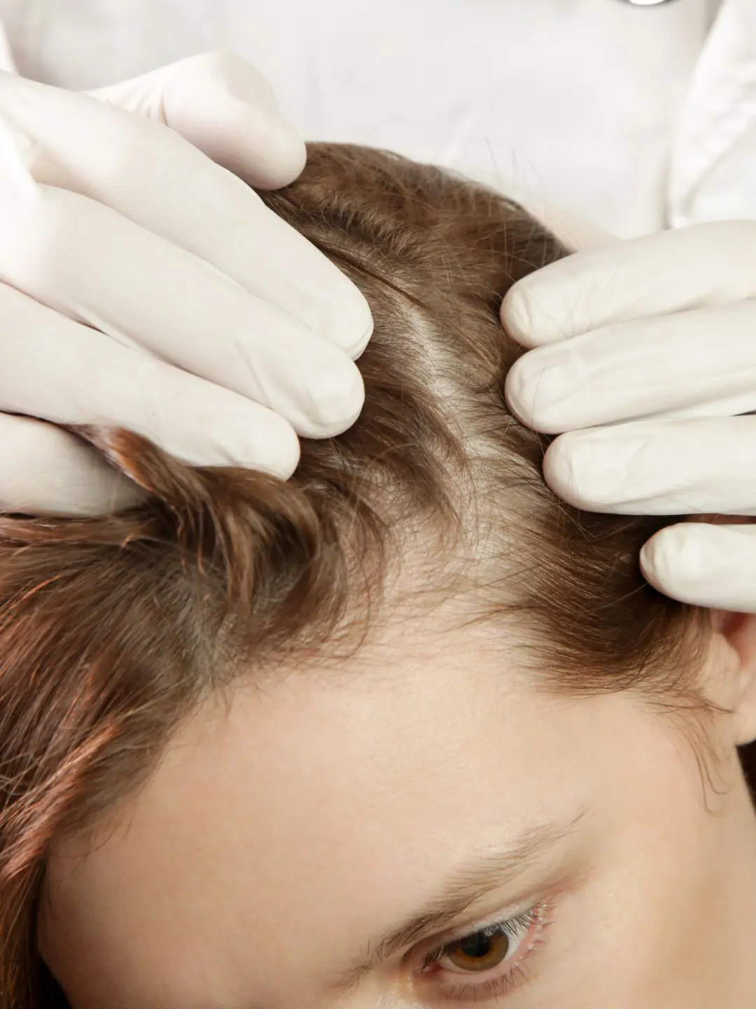 Queda de cabelo na mulher: dicas de tratamento.