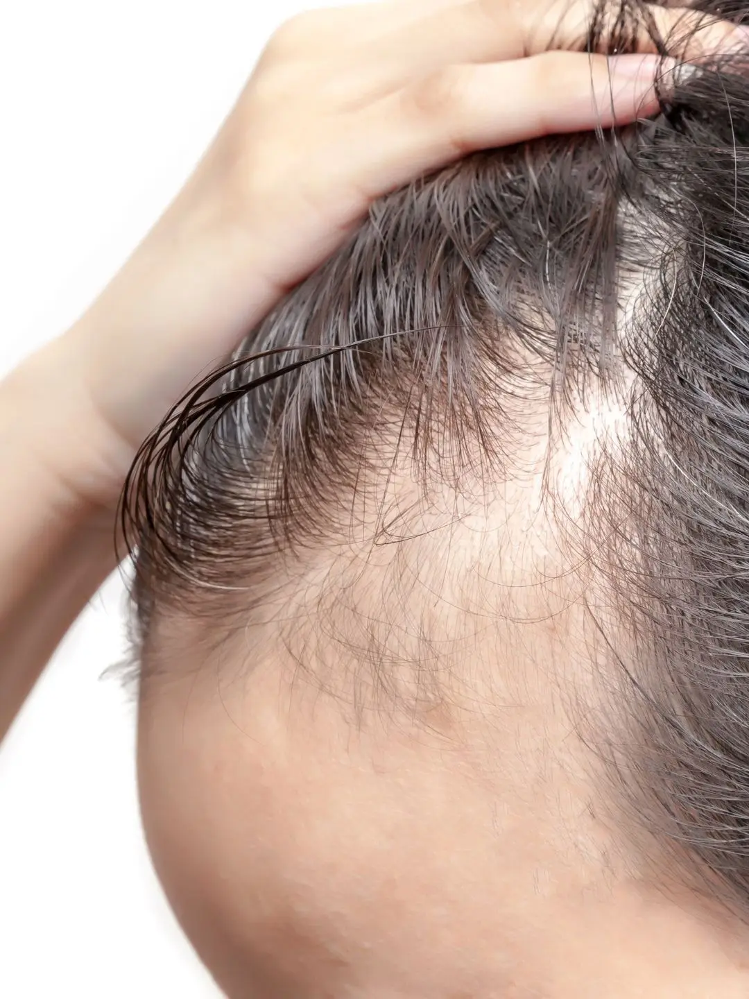 Queda de cabelo na mulher: dicas de tratamento.